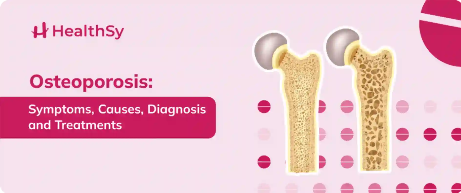 Osteoporosis: Symptoms, Causes, Diagnosis and Treatment